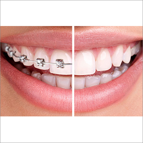 ortodonzia corregge anomalie dei denti